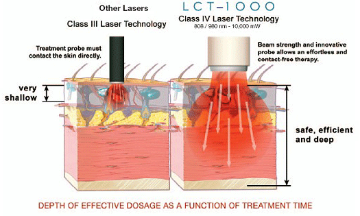 Deep Tissue Laser Therapy Treatment Comparison